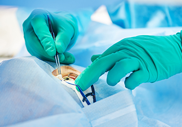 Chirurgia oculistica Clinica Napoli